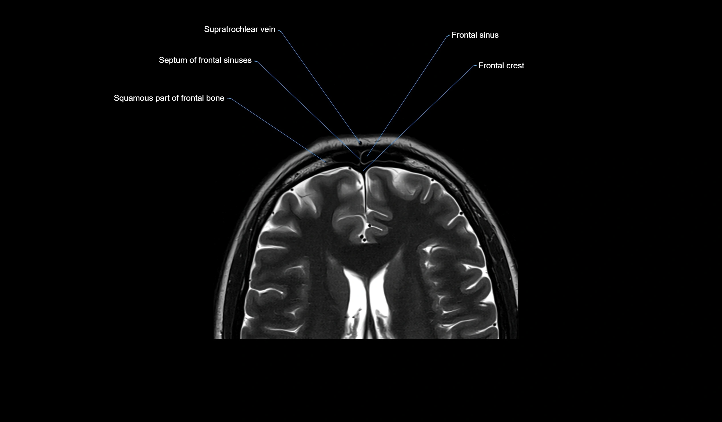 MRI face & paranasal sinuses(PNS) labelled  axial  cross sectional anatomy 3T radiology  image -00033.webp